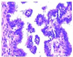 Epitelio seroso del tumor de
ovario borderline