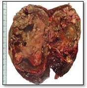 N&oacute;dulo con necrosis y degeneraci&oacute;n qu&iacute;stica, que ocupan casi todo el par&eacute;nquima espl&eacute;nico. (D 14-068).