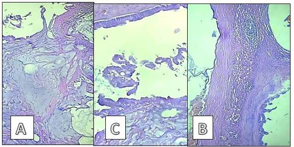 Microfotograf&iacute;a (20X) donde se observan grandes lagos de mucina (A). Quistes tapizados por epitelio mucinoso simple (B). &Aacute;rea de par&eacute;nquima espl&eacute;nico residual (C).