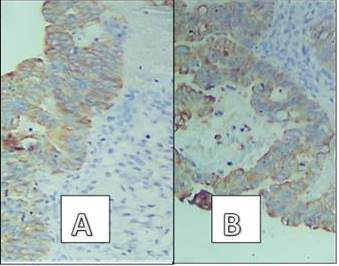 Expresi&oacute;n de citoqueratina 20 (A) y CDX 2 (B).