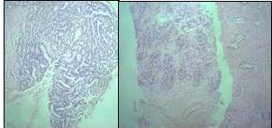 Biopsia por punci&oacute;n de pr&oacute;stata.