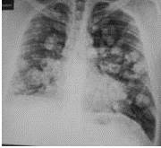 Radiografía de tórax: múltiples nódulos pulmonares bilaterales a nivel central y sub-pleural, con broncograma aéreo, con áreas de opacidad en vidrio esmerilado.