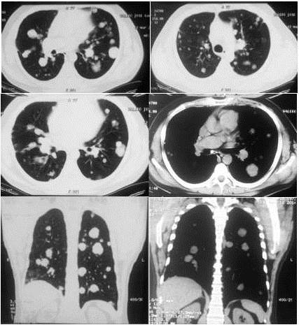 Tomografía BRIGHT SPEED de 16 detectores de tórax múltiples imágenes nodulares a nivel central y sub-pleural bilateral con tamaños que oscilan entre 0,6  cm y 3,1 cm, con valores de atenuación entre 23-43 UH. Se aprecia un aumento en la atenuación pulmonar con broncograma aéreo, asimismo, opacidades en vidrio esmerilado periférico bilateral, engrosamiento septos inter-lobulillares a predominio basal.