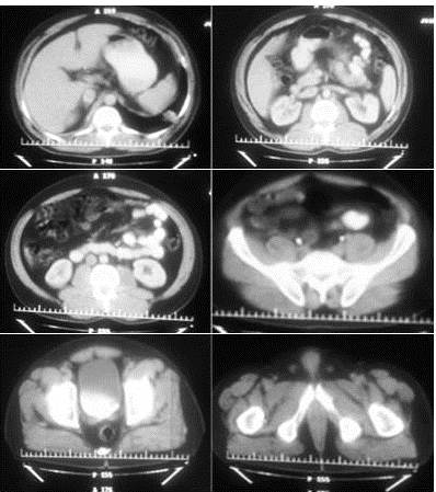 Tomografía abdominopélvica: sin evidencia de lesiones neoplásicas o inflamatorias de vísceras abdominopélvica