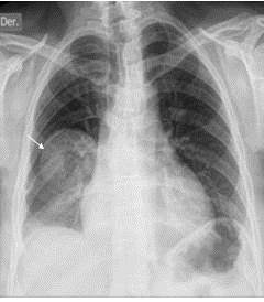 Radiografía de tórax. Imagen de masa tumoral en campo pulmonar derecho, homogénea de bordes bien definidos de distribución lobar (lóbulo inferior derecho) sub-pleural y asociada a pérdida de volumen.