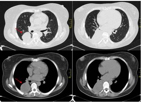 Tomografía de tórax: imagen de masa con márgenes bien definidos con morfología redondeada, que mide entre 9 cm x 7 cm, con valores de atenuación entre 23-43 UH, isodensa, contornos suaves en contacto con pared torácica y sub-pleural. Ausencia de adenopatías de la cadena mediastinal, supracarinalis y perihiliar.