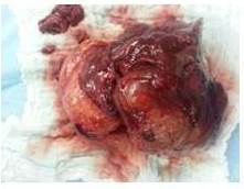 Tejido pulmonar, de color rojo vinoso de superficie lisa con trayectos vasculares finos, con formación tipo tumoral, que mide 8 cm x 6,5 cm x 3,5 cm, blanco amarillentos de consistencia firme.