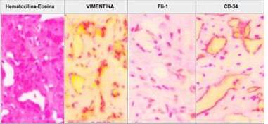 Inmunohistoquímica mediante técnica de avidina-estreptavidina, reportó inmunomarcaje en las células tumorales con VIM, HHF-35, Fli-1, lo cual correspondía a un hemangiopericitoma de pulmón.
