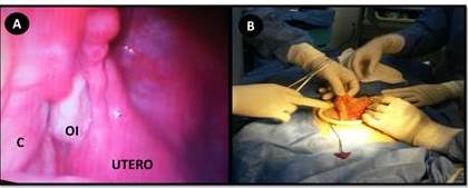 A. Biopsia definitiva: papilas intraqusticas complejas, con patrn cribiforme focal revestidas por un epitelio cilndrico, en reas con pleomorfismo nuclear, hipercromatismo y estratificacin. No se observ invasin estromal, ni figuras mitticas. (10 XC, tincin hematoxilina-eosina). B. Arquitectura tpica. Las papilas forman nidos de clulas epiteliales que se separan del estroma. La proliferacin de papilas no debe interpretarse como invasin del estroma. (40XC, tincin hematoxilina-eosina).