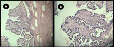  A. Imagen videolaparoscopica de tero y ovario izquierdo sin lesion. OI= Ovario izquierdo, C= Colon. B. Omentectoma a travs de dispositivo de un solo puerto.