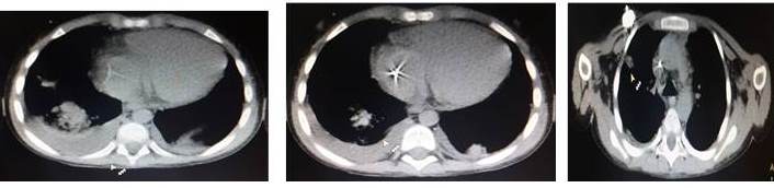 Previo tratamiento con anfotericina B