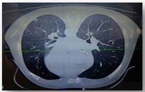 Posterior a tratamiento con anfotericina B (21 días)