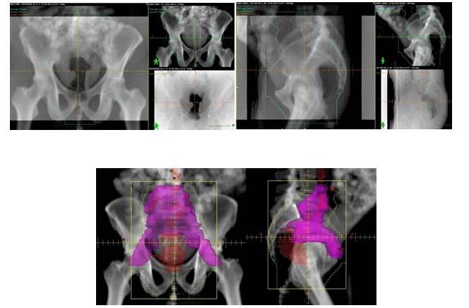 Dise&ntilde;o de los campos de tratamiento en el sistema de planificaci&oacute;n Eclipse se pueden observar los l&iacute;mites de los campos anterior posterior y laterales establecidos por el colimador multil&aacute;minas. Igualmente se se&ntilde;alan los contornos de los ganglios linf&aacute;ticos p&eacute;lvicos y del tumor (GTV).