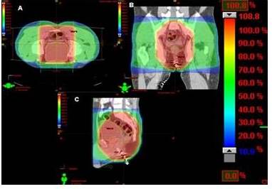 Figuras 3 y 4. Distribuci&oacute;n porcentual de la dosis indicada por las diferentes tonalidades de colores cuyos valores se pueden observar en la columna de la derecha e izquierda, en los planos axial, coronal y sagital. Las asas delgadas reciben una dosis significativamente menor. El paciente fue tratado en posici&oacute;n prona.