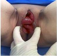 Prolapso de asas intestinales