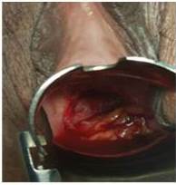 Deshicencia de cúpula vaginal