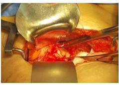 Cúpula vaginal abierta