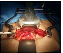 Reparación de cúpula vaginal