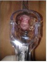 Especuloscopía contro 6 meses después de reparación quirúrgica