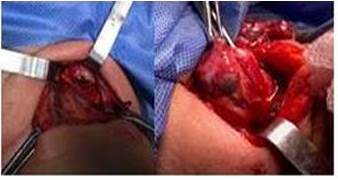 Tiroidectom&iacute;a  