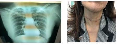 RX t&oacute;rax y resultado cosm&eacute;tico final