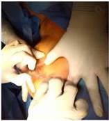 Canalizaci&oacute;n de trayecto fistuloso con yelco 14G