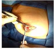 Fistulectom&iacute;a