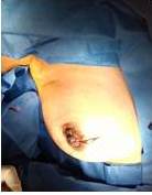 Puntos cardinales
sub-cuticulares.  

Sutura
absorbible poligactina 910  