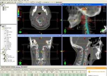 Imágenes
del sistema planificación, se aprecia un corte en los 3 planos (axial, coronal
y sagital) con la delimitación de la lesión macroscópica y las proyecciones de
ambos campos laterales opuestos (derecho e izquierdo).