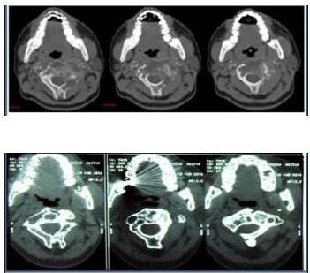 Imágenes comparativas de tomografía
donde se observa mejoría a nivelradiológicodada por la disminución del
componente heterotópico de la lesión y formación del callo óseo.