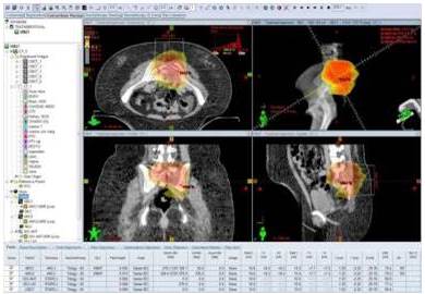 Imágenes del sistema planificación, se aprecian un corte en los 3 planos
(axial, coronal y sagital) con la distribución del 100 % de la dosis en color
rojo en el área de la lesión macroscópica.