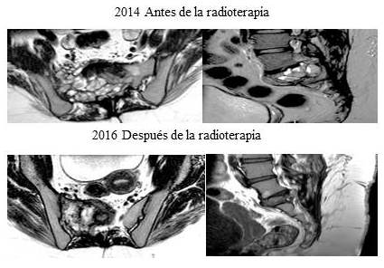 Cortes
axiales y sagitales de resonancia en secuencia T1 que muestra el patrón típico
en “panal de abeja” y luego se observa notable mejoría por disminución de la
heterogeneidad y tamaño de la lesión.