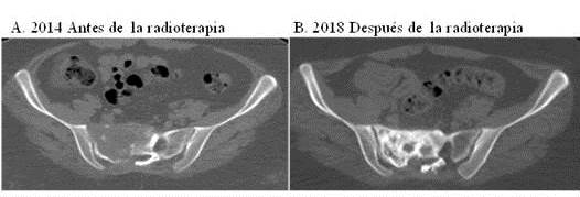 Imágenes comparativas de
tomografía en corte axial donde se observa mejoría radiológica dada por la
formación del callo óseo.