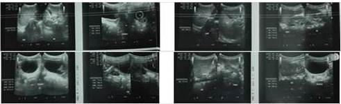 Se evidencia LOE ovario izquierdo, con ascitis moderada.