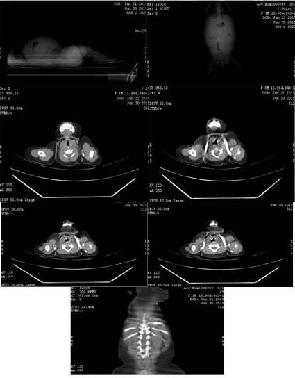Im&aacute;genes de la
tomograf&iacute;a axial computarizada, donde se evidencia tumor intra-p&eacute;lvico.