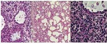 Cortes
histol&oacute;gicos del TCG que muestran c&eacute;lulas medianas con escaso citoplasma
eosin&oacute;filo,  nucl&eacute;olos prominentes y  con hendiduras en granos de caf&eacute;. 

 