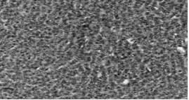 Tumor de la granulosa. (HE 200 x). Patr&oacute;n difuso.