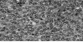 Tumor de la granulosa. (HE 400
x). Detalle de la anterior en la que se observan c&eacute;lulas de tama&ntilde;o uniforme,
con citoplasma eosin&oacute;filo y n&uacute;cleos redondos con escaso pleomorfismo. Una
figura de mitosis en el centro.