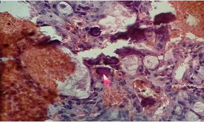  La
imagen representa la expresi&oacute;n de cuerpos de psammoma
(flecha color rosa), en tejido correspondiente a la c&uacute;pula vaginal