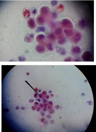 Citolog&iacute;a
de c&uacute;pula vaginal en la cual se observan c&eacute;lulas epiteliales glandulares
aisladas en grupos y papilas con atipias.