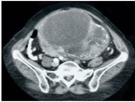 Imagen de tomograf&iacute;a computada que demuestra tumoraci&oacute;n
p&eacute;lvica hiper-ecog&eacute;nica y compleja sin infiltraci&oacute;n de &oacute;rganos adyacentes.