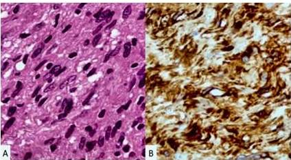  Imagen microscopia compatible con schwannoma
p&eacute;lvico retroperitoneal benigno con &aacute;reas de patrones de celularidad compacta. A) Coloraci&oacute;n hematoxilina-eosina, 40X. B)
Coloraci&oacute;n inmunohistoqu&iacute;mica intensa para prote&iacute;na S100, 40X.  

 