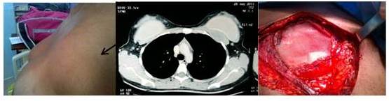 Paciente con fibromatosis de mama al examen f&iacute;sico inicial, TAC de t&oacute;rax y al
momento de la resecci&oacute;n quir&uacute;rgica.