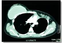 Paciente con fibromatosis de mama control
TAC t&oacute;rax 30 meses posterior a la cirug&iacute;a.