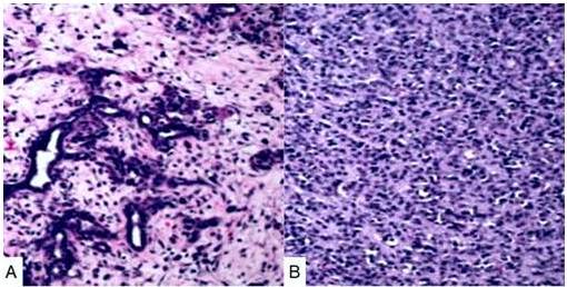 Microfotografa del tumor ovrico de clulas de Sertoli-Leydig en la que se observa: A) Clulas de Sertoli dispuestas en tbulos huecos y cordones con estroma edematoso B) reas poco diferenciadas de clulas de Sertoli inmaduras con patrn de crecimiento difuso.