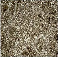 Evaluacin inmunohistoqumica que muestra inmunotincin positiva para calretinina de las clulas neoplsicas.