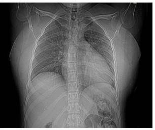 Radiograf&iacute;a de t&oacute;rax: defecto localizado en el &aacute;ngulo interno del
tercer (3er) arco costal izquierdo,
de aspecto l&iacute;tico con aparente abombamiento del periostio y p&eacute;rdida de
sustancia &oacute;sea.