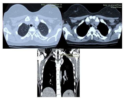 omograf&iacute;a de t&oacute;rax multidectector corte axial y coronal: Lesi&oacute;n &uacute;nica ocupante de
espacio afectando tercer (3er) arco costal posterior izquierdo expansiva, porci&oacute;n central hipodensa de comportamiento
osteol&iacute;tico, con remodelaci&oacute;n, adelgazamiento y expansi&oacute;n de la cortical
(flechas blancas).