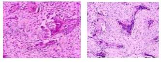 Microfotograf&iacute;a. Lesi&oacute;n consistente en una
proliferaci&oacute;n fibrosa, que sustituye al hueso normal, en la que se producen
trab&eacute;culas &oacute;seas, gr&aacute;ciles e irregulares &ldquo;caracteres chinos&rdquo;, bordeadas por
osteoblastos displasia osteofibrosa.