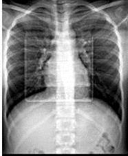 Radiografía de tórax. No se evidenció imagen compatible a lesiones, ni trazos de fractura